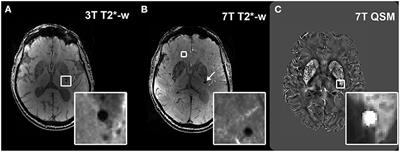 Implications of quantitative susceptibility mapping at 7 Tesla MRI for microbleeds detection in cerebral small vessel disease